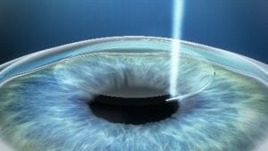SMILE Eye Surgery Fort Worth SMILE Eye Surgery Procedure Diagram #1