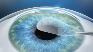 SMILE Eye Surgery Hurst SMILE Eye Surgery Procedure Diagram #2