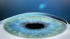 SMILE Eye Surgery Weatherford SMILE Eye Surgery Procedure Diagram #3