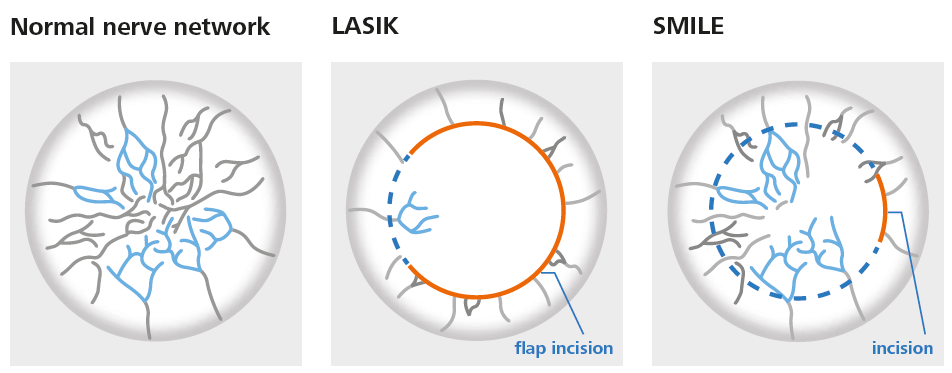 This image shows a side-by-side of the normal nerve network of the eye, after LASIK, and after SMILE