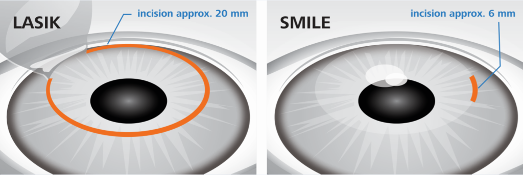 LASIK vs. SMILE eye surgery procedure diagram