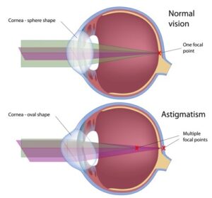 diagram of an eye with astigmatism