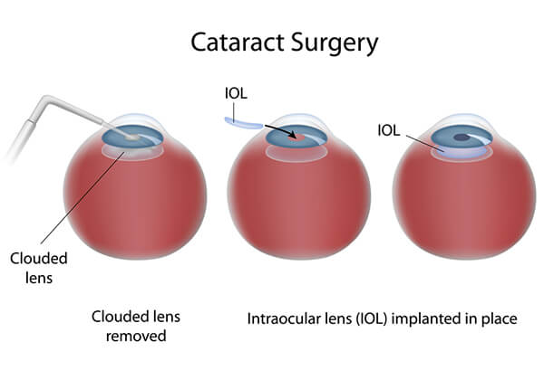 Chart Showing the Cataract Surgery Procedure