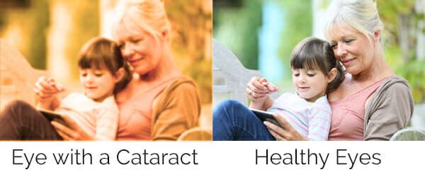 Vision comparison with and without cataracts