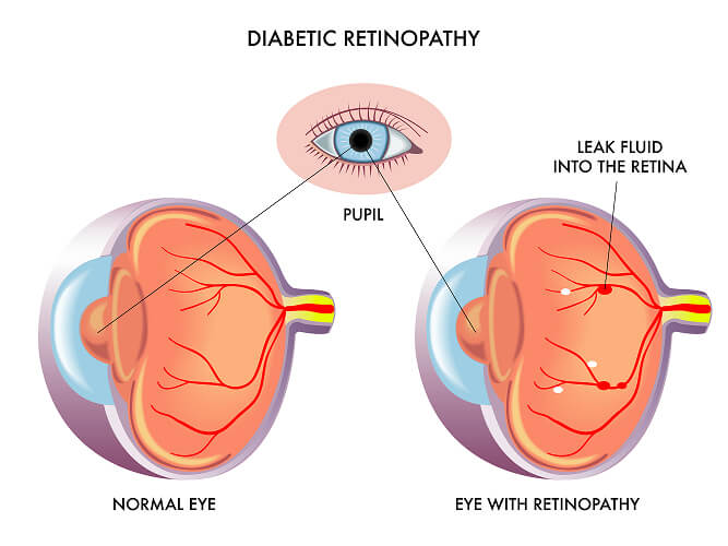 Chart Showing How Diabetic Retinopathy Affects the Eye