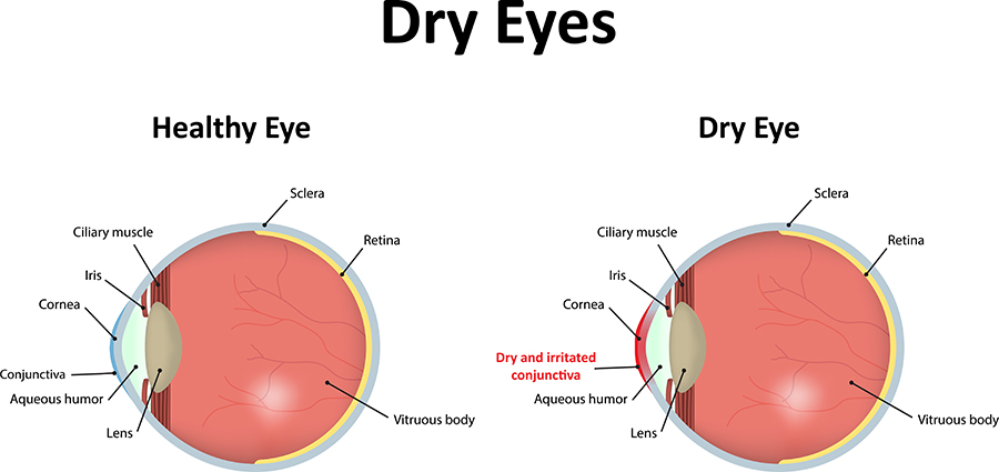Dry Eyes Chart