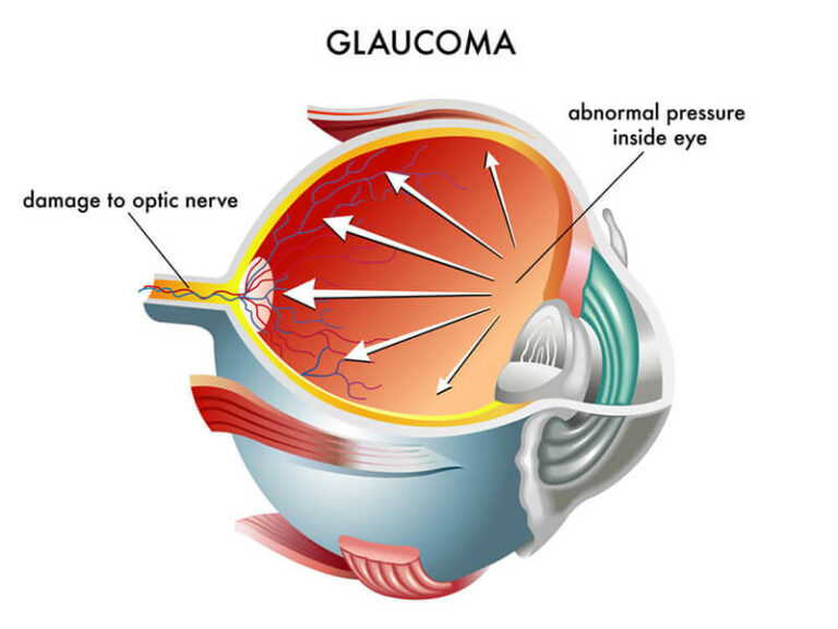 Chart Showing How Glaucoma Affects an Eye