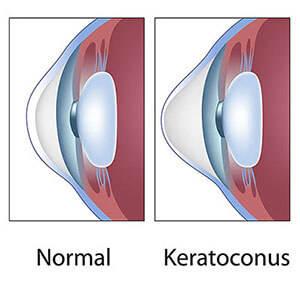 Chart Showing a Normal Eye Vs One With Keratoconus