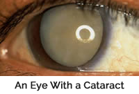 Cataract Fort Worth Cataract Example