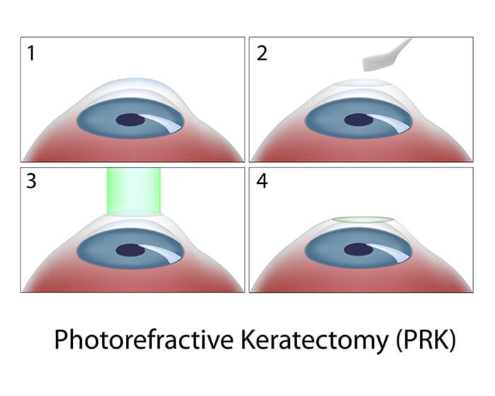 Chart Showing the PRK Surgery Process