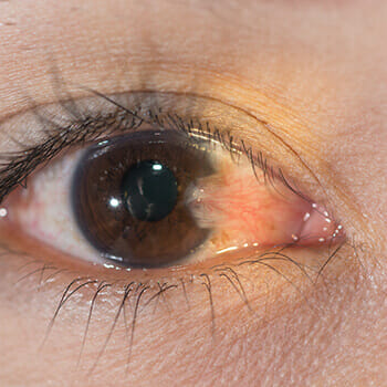 Eye With Pterygium