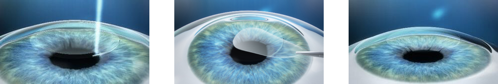 Corrective Eye Surgery Smile Corrective Eye Surgery Smile